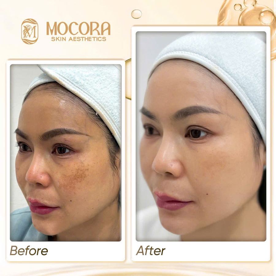 Kết quả chăm sóc nám chân sâu tại Mocora