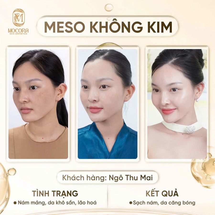 Kết quả liệu trình Meso Ultraface tại Mocora