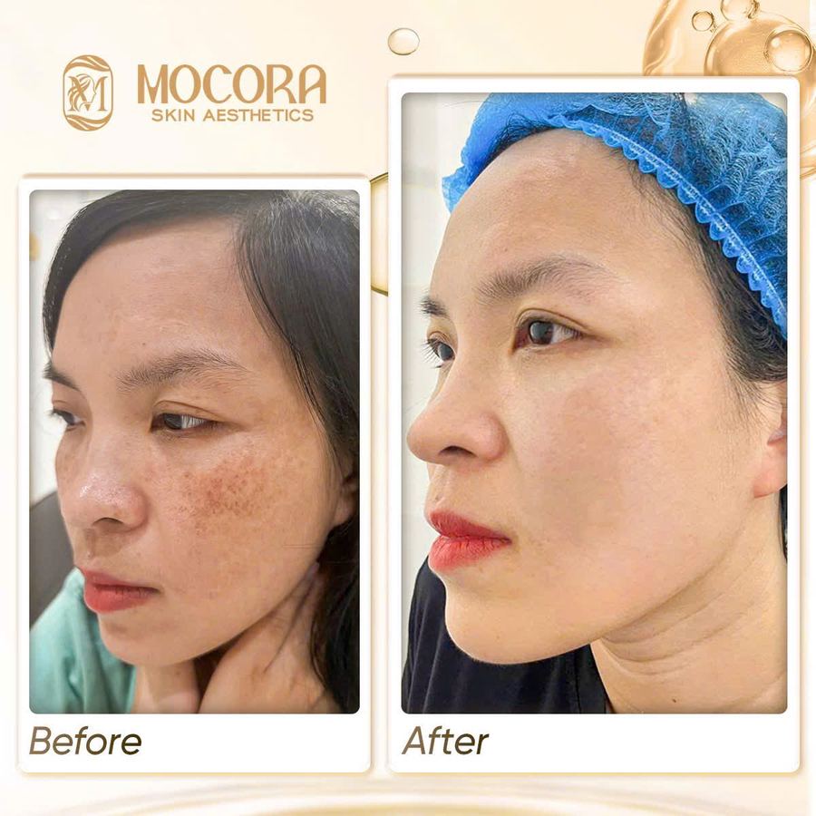 Kết quả cân bằng sắc tố nám mảng tại Mocora