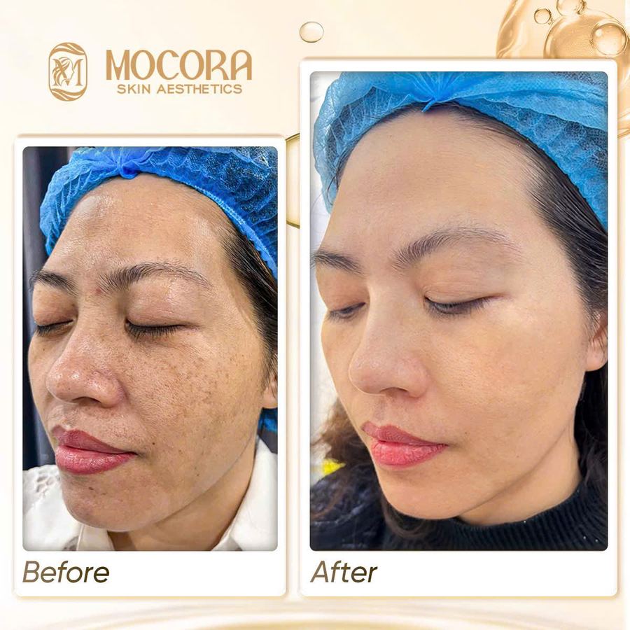 Kết quả chăm sóc nám hỗn hợp tại Mocora