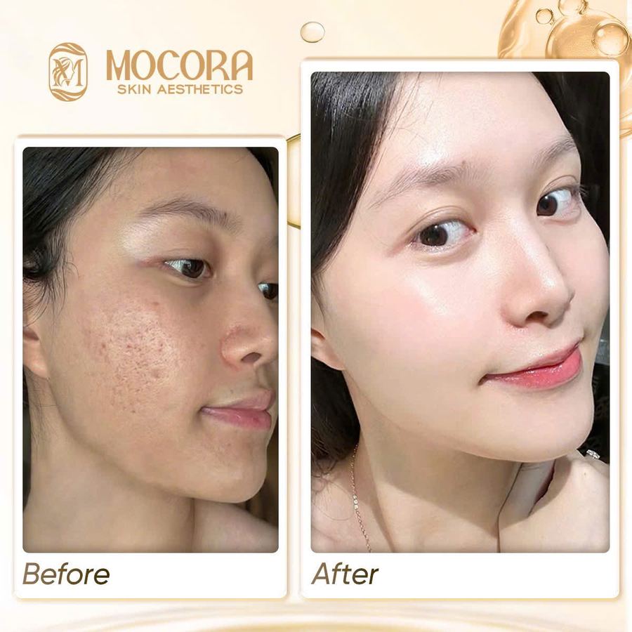 Kết quả chăm sóc phục hồi đều màu da tại Mocora